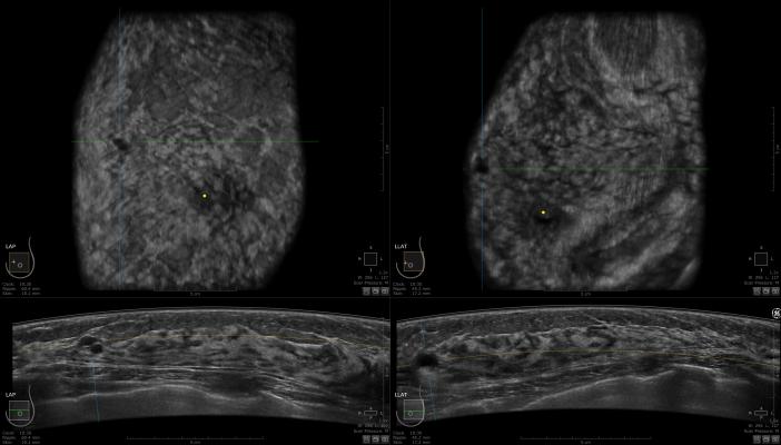 GE Invenia ABUS Aids Cancer Detection in Dense Breasts | Imaging